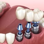 5 Mistakes to Avoid After Dental Implant Surgery