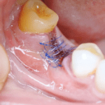 Wisdom tooth stitch removal explained by Topeka Oral Surgery