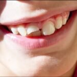 Chipped tooth emergency care - Topeka Oral Surgery