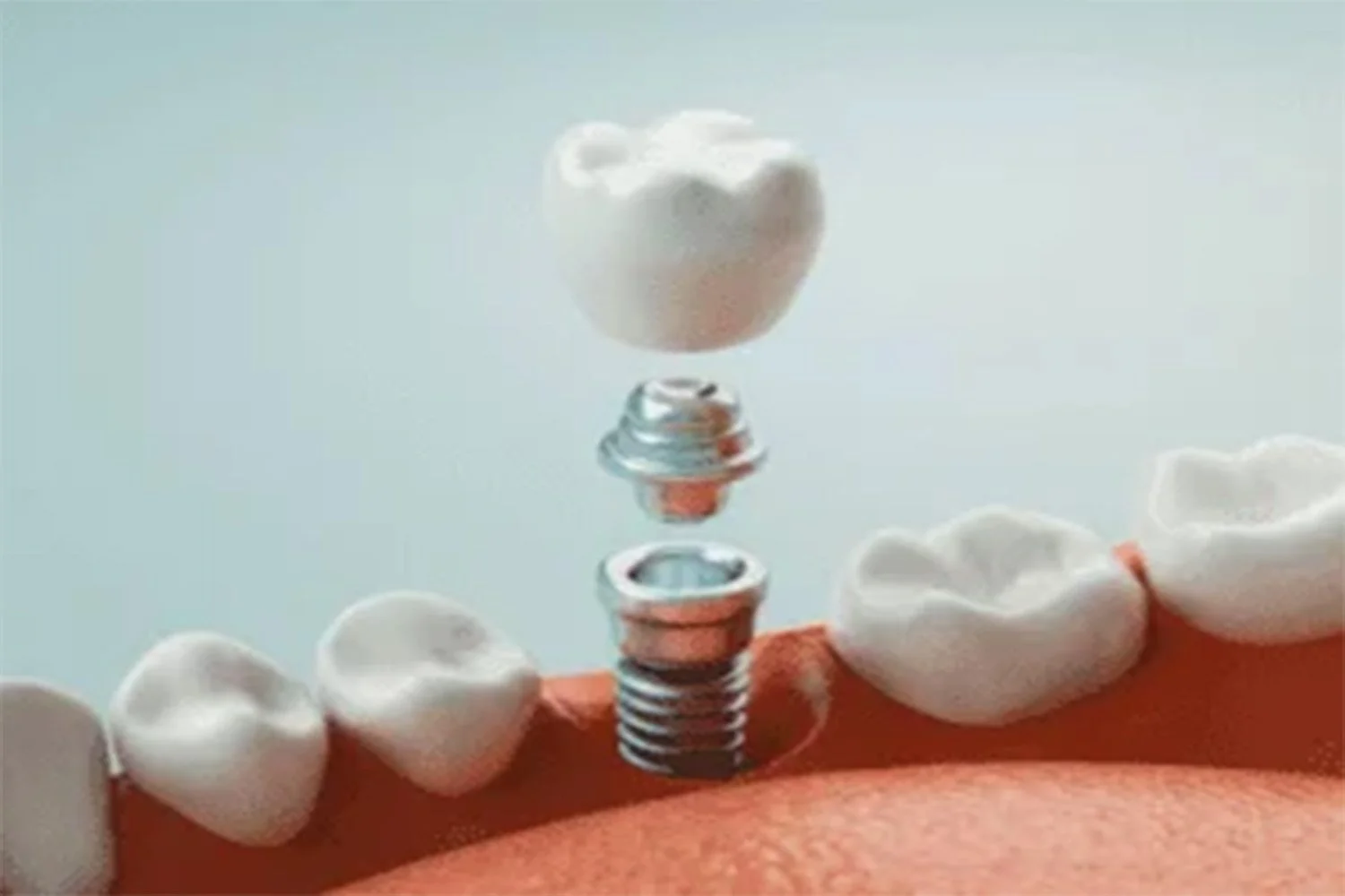 5 Interesting Facts About Dental Implants – Topeka Oral Surgery