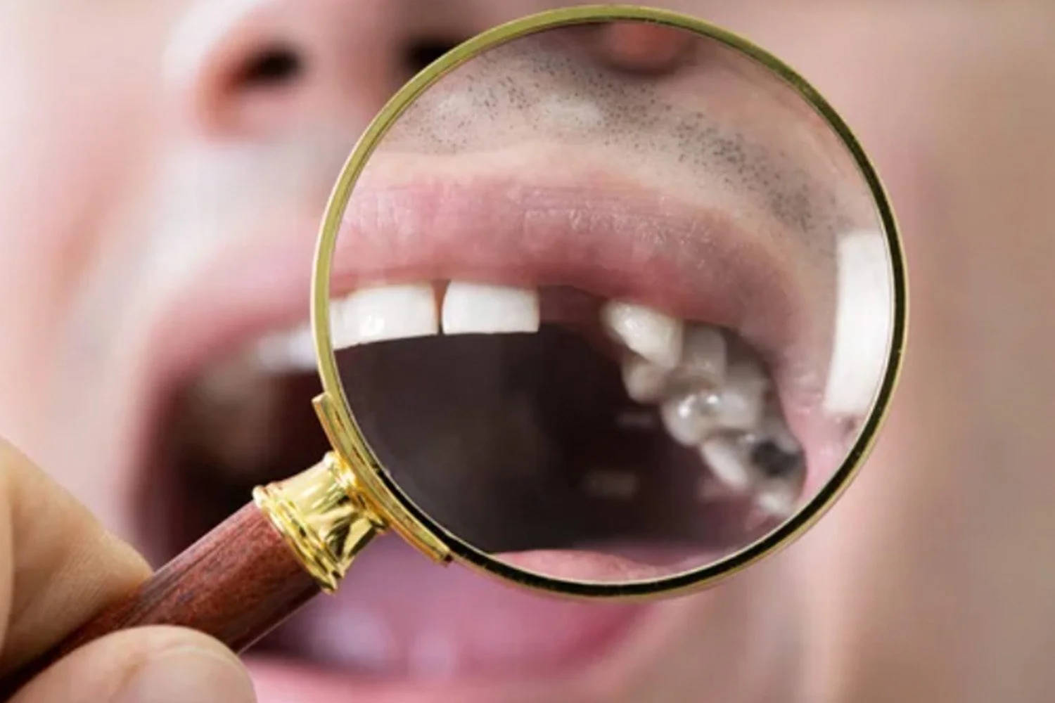 5 Reasons You Shouldn’t Ignore Missing Teeth
