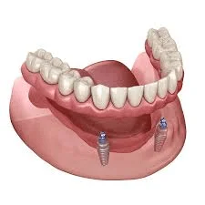 Are Implant Supported Dentures Removable?