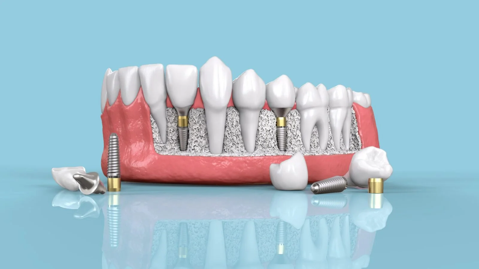 5 Mistakes to Avoid After Dental Implant Surgery