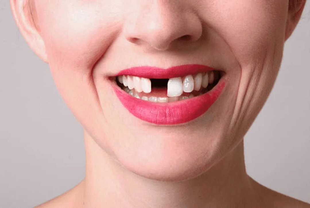 What Happens If a Missing Tooth Is Not Replaced