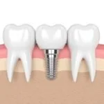 Oral Surgery