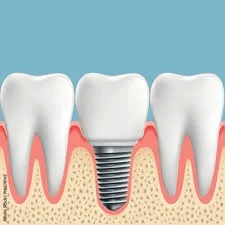 Are Dental Implants Painful After Surgery?