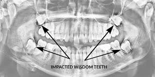How to Prepare for Your Wisdom Teeth Removal?