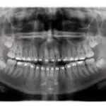 Wisdom teeth removal at Topeka Oral Surgery