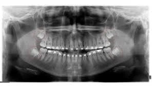 7 Reasons Why You Should Remove Wisdom Teeth?