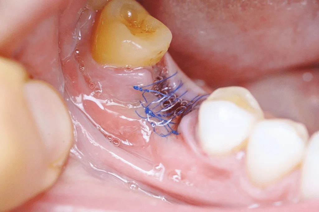 Do I Need to Have Stitches Removed After My Wisdom Tooth Procedure?