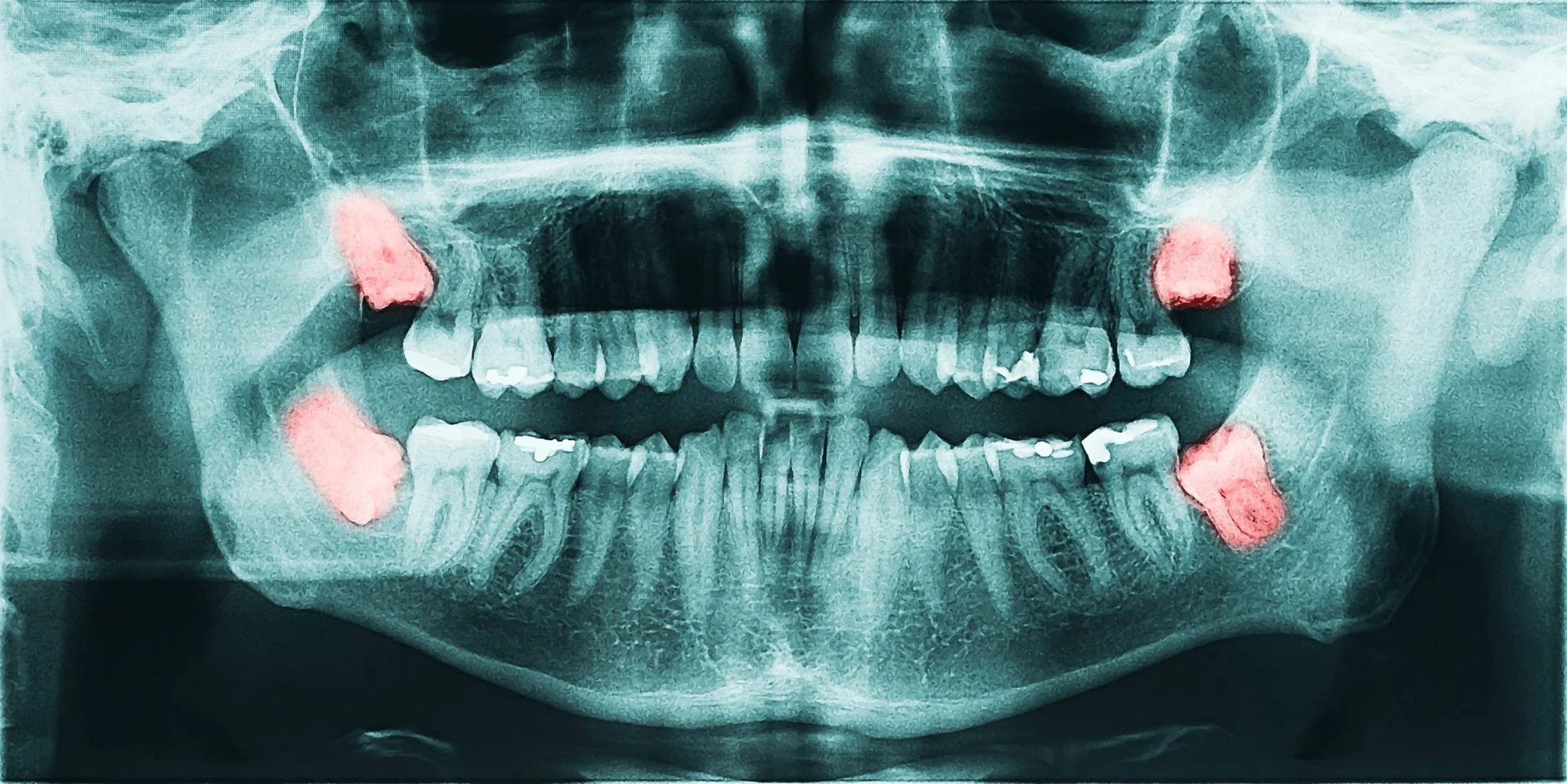 What are Dry Sockets After Wisdom Teeth Removal?