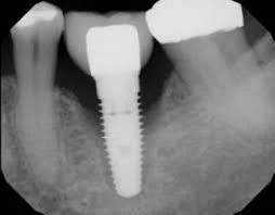 &nbsp;What Happens When a Dental Implant Fails and How to Handle It?