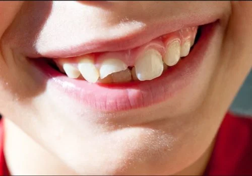 &nbsp;Broken or Chipped Teeth: Emergency or Urgency