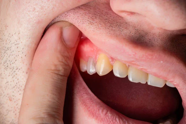Dental Abscess: Why It’s a Medical Emergency