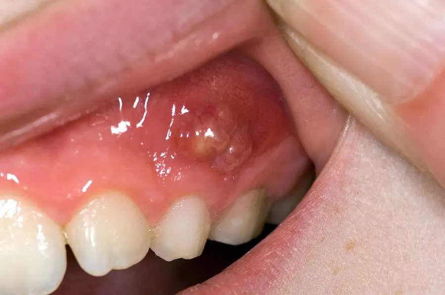 &nbsp;Dental Abscess: Why It’s a Medical Emergency