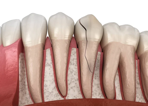 Lost Fillings or Crowns: Is It an Emergency?