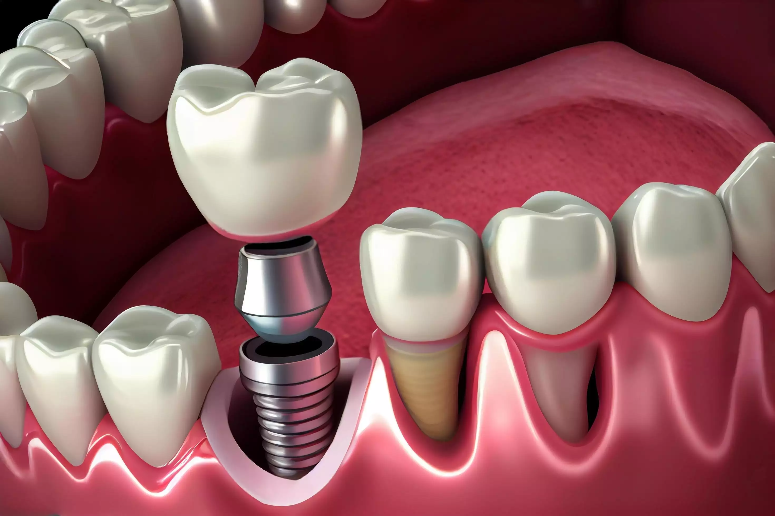 The History of Dental Implants: From Ancient Roots to Modern Marvels