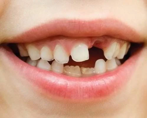 How to Handle a Knocked-Out Tooth&nbsp;