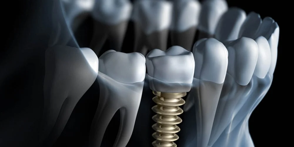 The Benefits of Dental Implants: A Comprehensive Guide