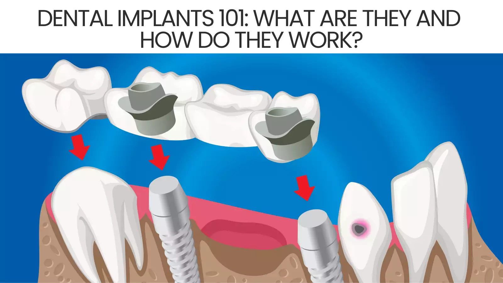 Dental Implants 101: What Are They and How Do They Work?