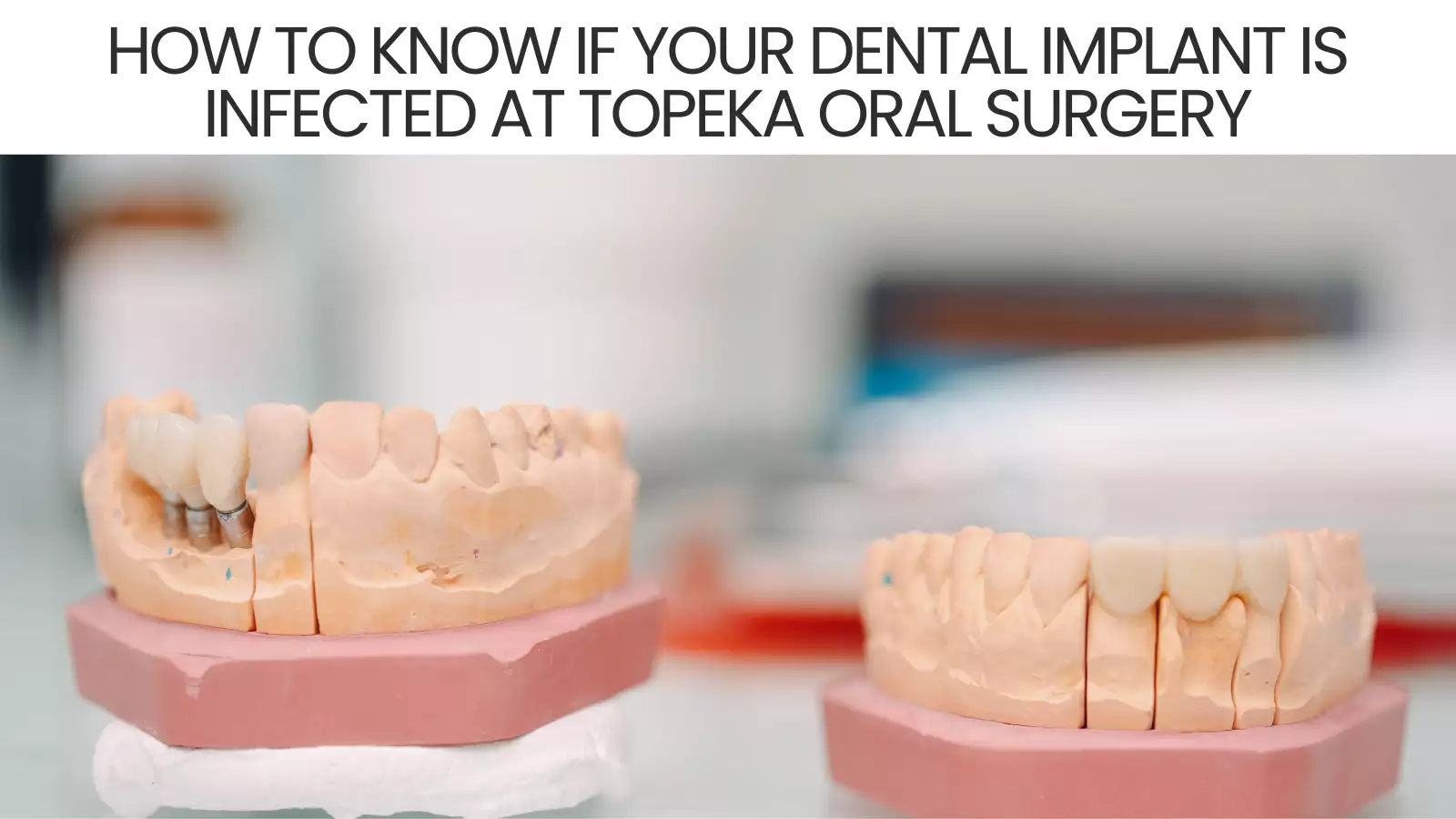 How to Know if Your Dental Implant Is Infected at Topeka Oral Surgery