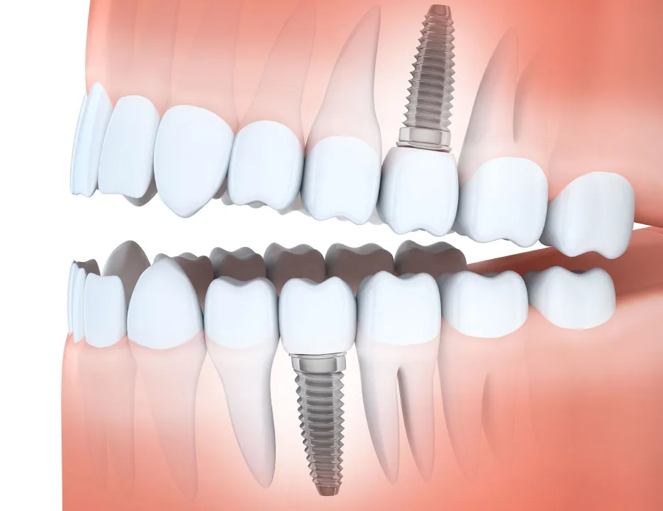 Is Getting a Dental Implant Painful?&nbsp;