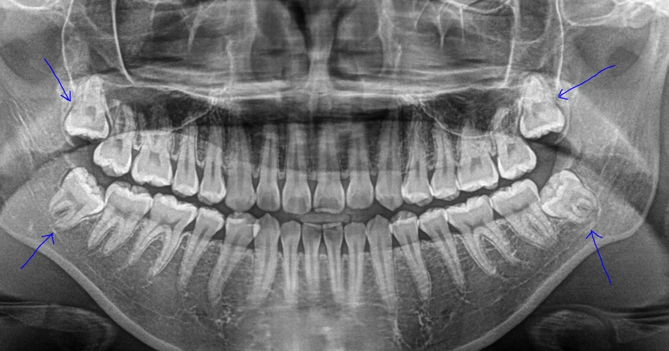 5 Reasons It’s Time to Get Your Wisdom Teeth Removed