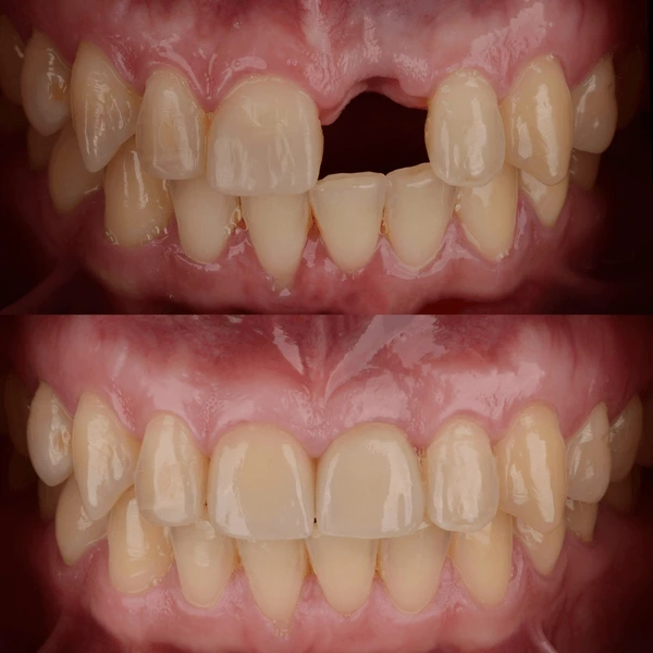 Can Dental Implants Be Used for Front Teeth at Topeka Oral Surgery?