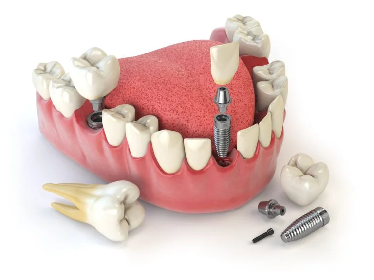 Same-Day Dental Implants at Topeka Oral Surgery