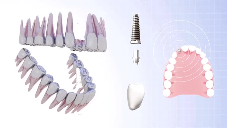 Titanium Dental Implants at Topeka Oral Surgery